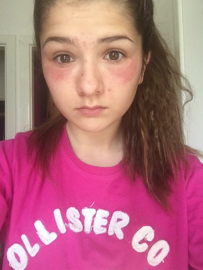 epiduo forte moisturizer