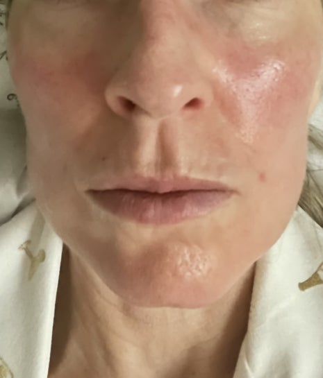 52 year old caucasian healthy female Botox caused smoker s