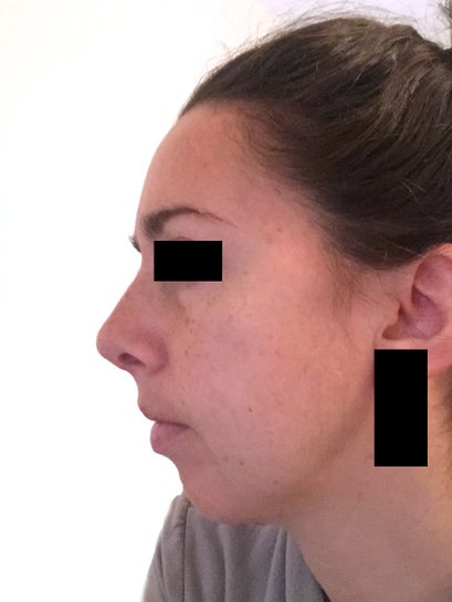 upturned nose profile