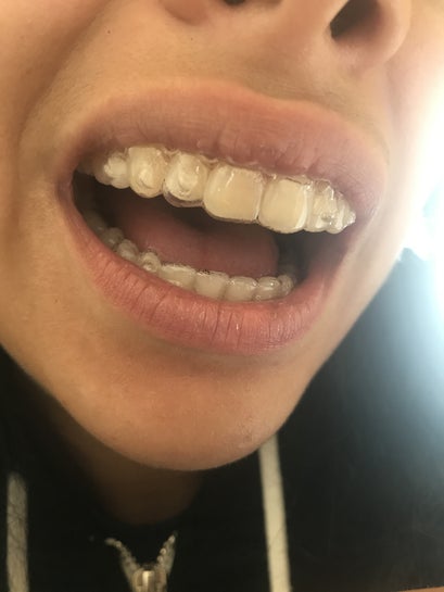 I&rsquo;ve told my dentist a tooth hasn&rsquo;t moved at all but she says it&rsquo;s 