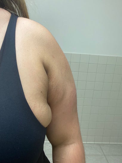 Axillary/Armpit Breast and Fat Tissue Removal