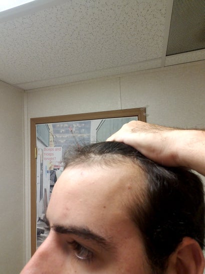 I am a 21 year old looking for advise on how to approach receding hairline? (photo) I am a 21 year old looking for advise on how to approach receding hairline? (photo)