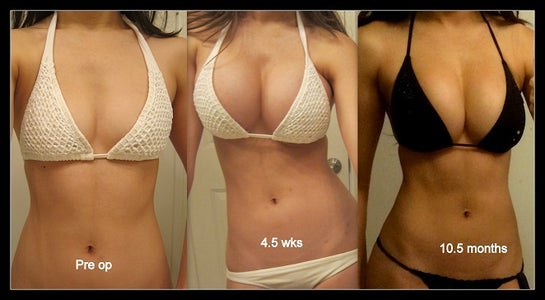 Wide gap between breast implants! Why do they fall to the side
