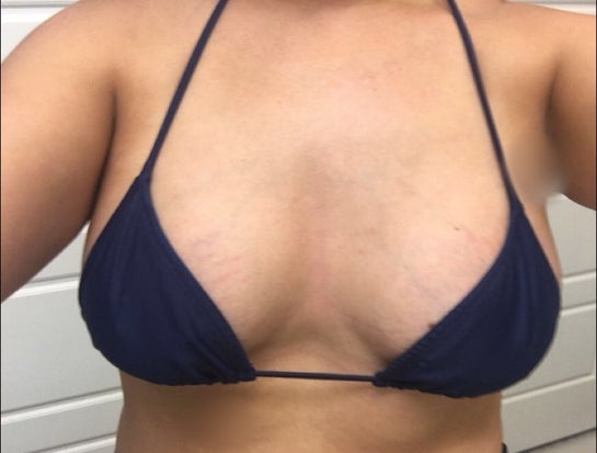 6 mos post-op. Could my breasts have been placed closer together for a  rounder cleavage? (Photos)