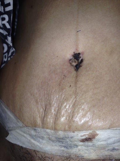 Tummy Tuck Abdominoplasty Scars