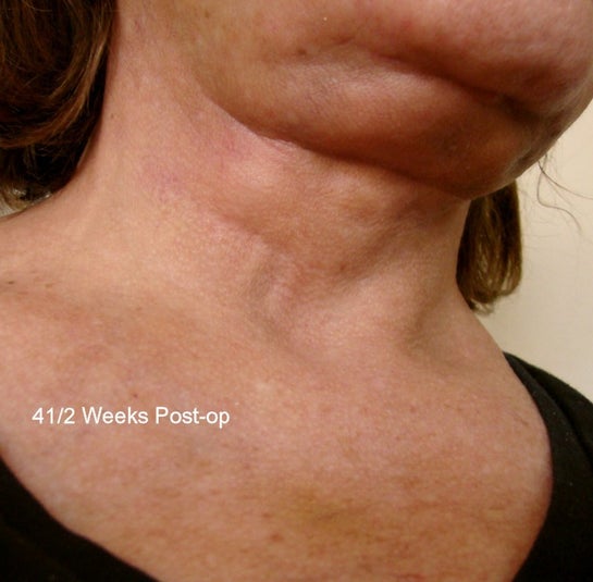 What should I do about complications from a Mid face/Neck lift, 4