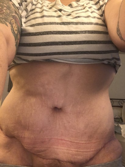 Tummy tuck gone wrong? 2 months post op. (photos)