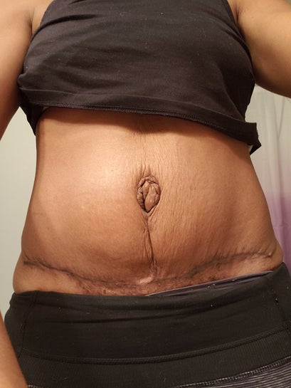 I'm 8 weeks post op with my tummy tuck. How much of my abdominal
