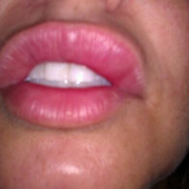 Lips on small bumps tiny Cold Sore