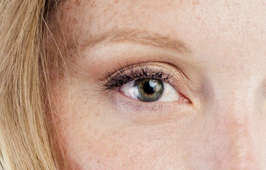 eyelid surgery complications