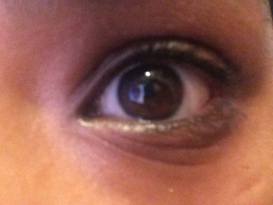 lines under eyes at 16