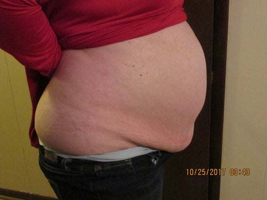 When is diastasis recti considered a medical necessity so covered by  insurance? (photos)