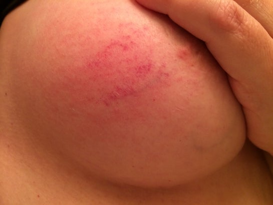 What could cause sudden red, itchy bruise looking spot on breast