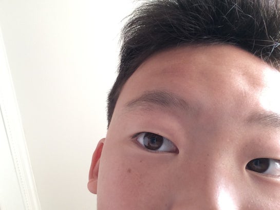 How Can I Get Rid Of The Dent On My Forehead Photo