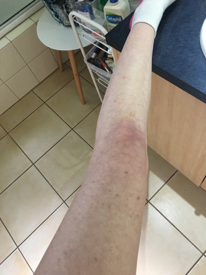 How to fade bad red and purple scarring on legs as fast as possible?  (photos)