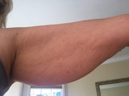 Cellulite on biceps 2025