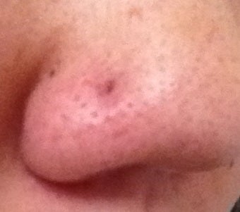 nose piercing close up scar