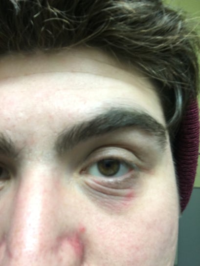 I Am 18 With Eye Bags Wrinkles Possibly Dennie Morgan Lines What Should I Do To Treat It Photos