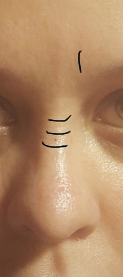 Fine lines on nose bridge between eyes. Caused by facial