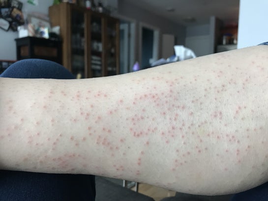 Why do I have a red bumpy rash after laser hair removal photos