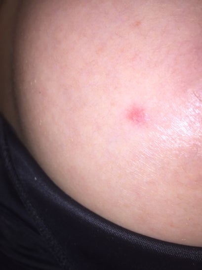 What is this little red mark same area outside nipple on both