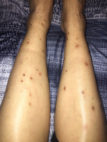 Would laser scar removal work to get my pretty legs / skin back? How  quickly? Pricing? (Photo)