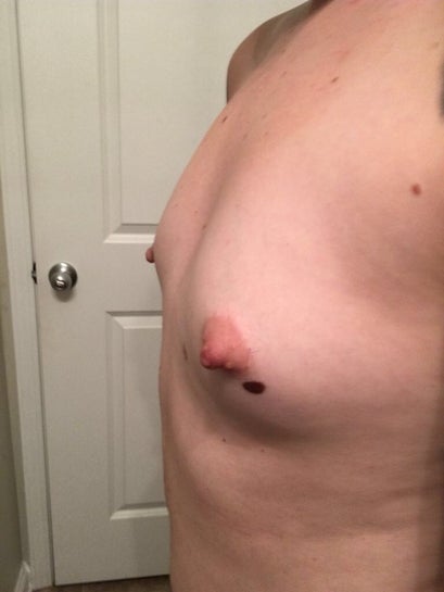 Should I get implants if my breasts are too far apart? (Photo)