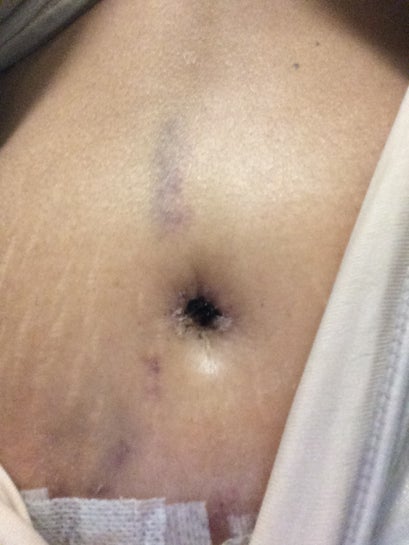 Bruised belly deals button piercing