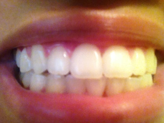 Front teeth missing two What Do
