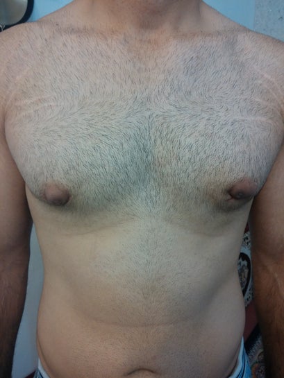 Almost 2 months post gynecomastia surgery. Still got puffy and