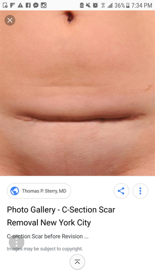 I Have A Painful Depressed C Section Scar Would Cigna Cover A Revision Photo