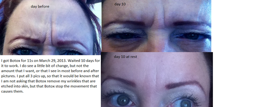 Botox Not Working For 11s After 10 14 Days Photo Botox Not Working For 11s After 10 14 Days Photo