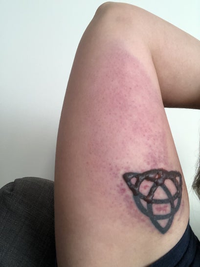 Three days after third session this bruise is GNARLY I tend to bruise  pretty easily in general but holy crap Any reason why my tattoo bruised up  so much more this time