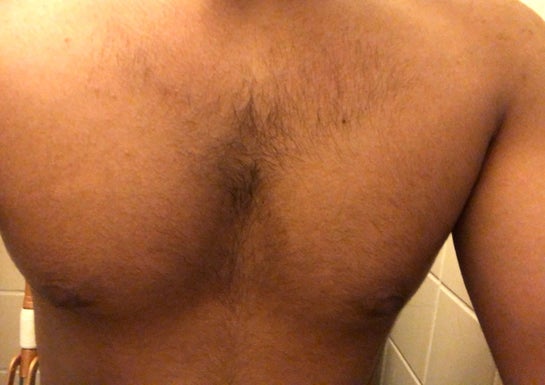 Is this gynecomastia: My nipples are puffy and point outwards. I am 5'7 and  weigh 155 lbs. (Photos)