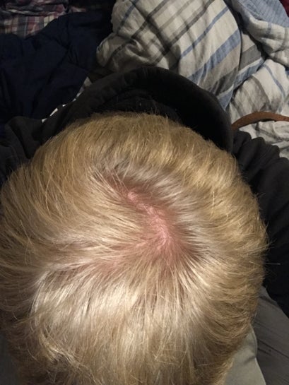 Is this a cowlick or am I balding? I have no history of balding in my family and the cowlick is getting bigger. (photo) Is this a cowlick or am I balding? I have no history of balding in my family and the cowlick is getting bigger. (photo)