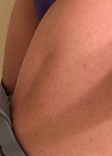 Dent On My Left Thigh Vaccine Complication Is It Fixable Photo