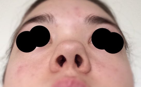 What Can Be Done For My Square Nose Photos