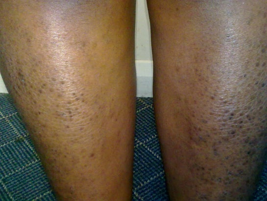 Dark Spots on Legs. How Do I Get Rid of Them?