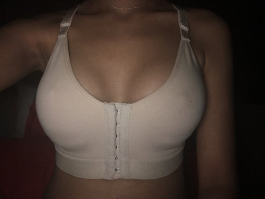 1 week post-op, will I now always have one boob bigger than the other?  (photos)