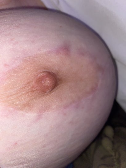 Nipple ring hotsell scars