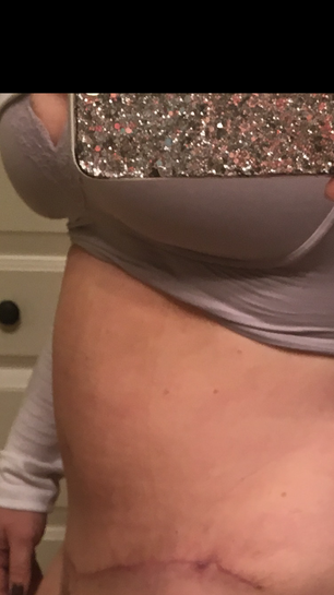 Upper abdominal swelling after Tummy Tuck. Is 7 weeks too early to see this  type of swelling? (Photo)
