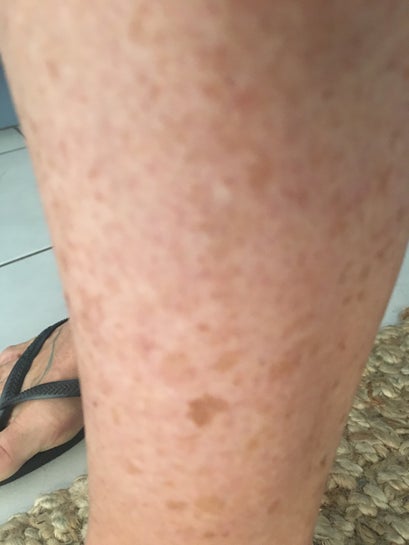 Removal Of Age Spots Sun Spots On Hands Arms And Legs Photo