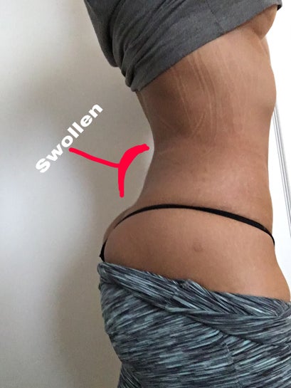 Yay or Nay: Compression Garments after Lipo - Costhetics