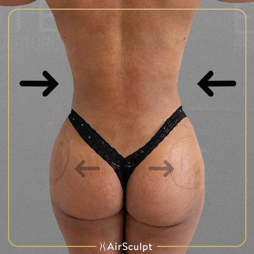 Reviewing DeLeesa Unique's Atlanta AirSculpt® Hip Flip™ Treatment