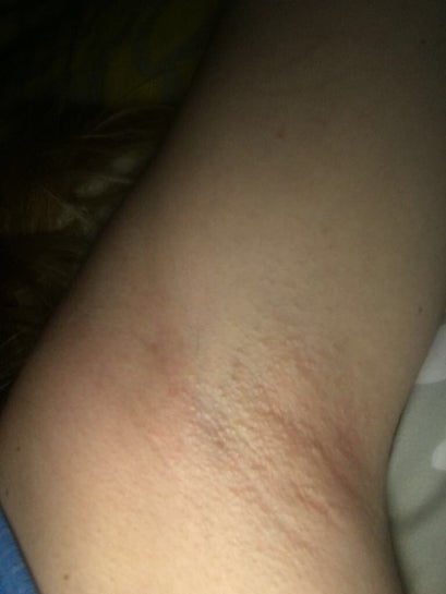 Bumps one year after laser hair removal Photos