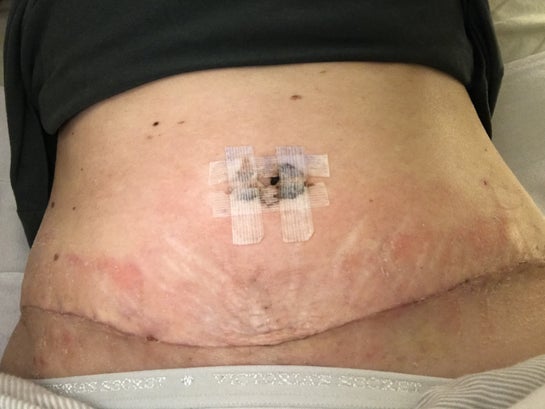 5 days PO - allergic reaction to dermabond : r/tummytucksurgery