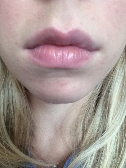 Cupid's Bow Lips Are the Newest Trend in Fillers - James Christian New  York's Injectable Expert