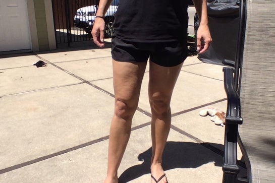 cellulite on calf