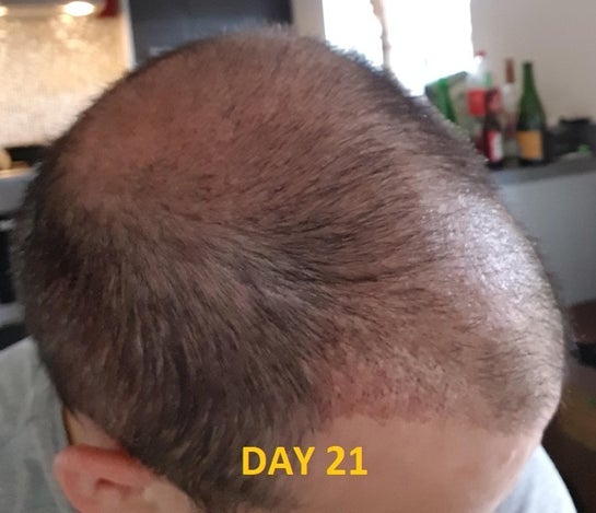 Share 129+ hair transplant after 20 days super hot