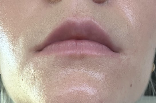 Would lip filler achieve a natural and more symmetrical look photos